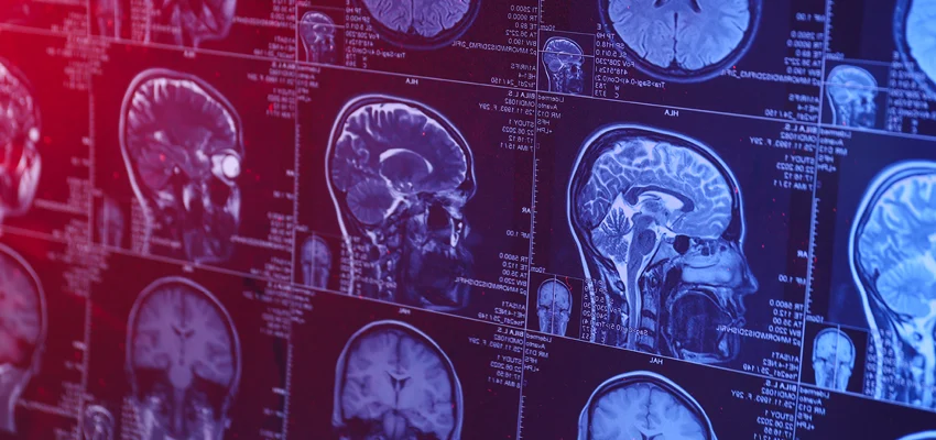 Is Brain Strain a Hidden Cost of Hearing Loss?